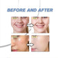 AzeClear™ 20% Azelaic Acid Acne Cream