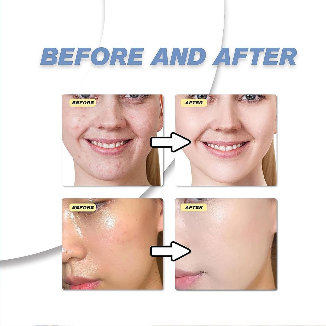 AzeClear™ 20% Azelaic Acid Acne Cream