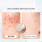AzeClear™ 20% Azelaic Acid Acne Cream