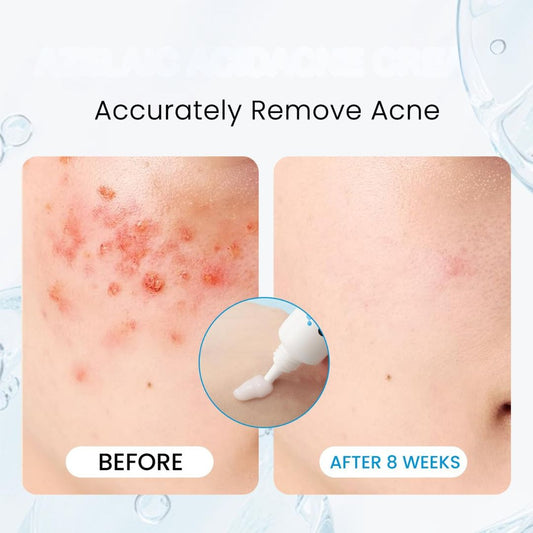 AzeClear™ 20% Azelaic Acid Acne Cream