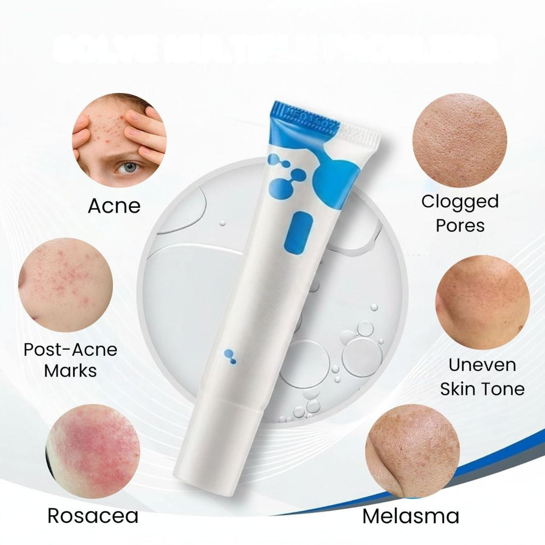 AzeClear™ 20% Azelaic Acid Acne Cream
