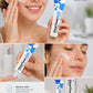 Azelaic Acid Acne Cream